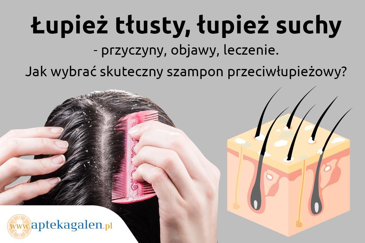 leczenie lupiezu szampon z