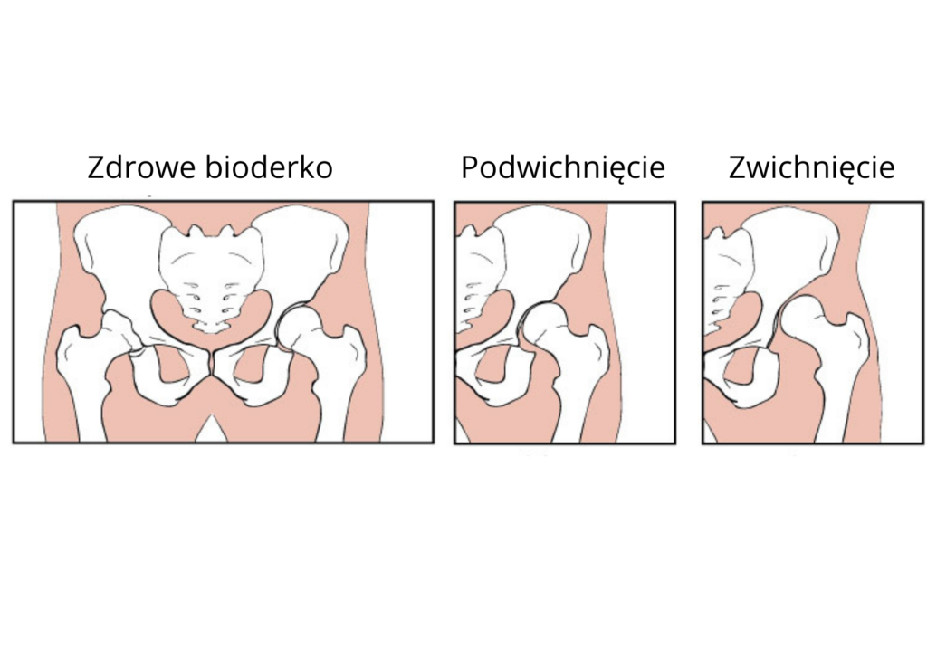 pieluchy flanelowe dysplazja bioderek