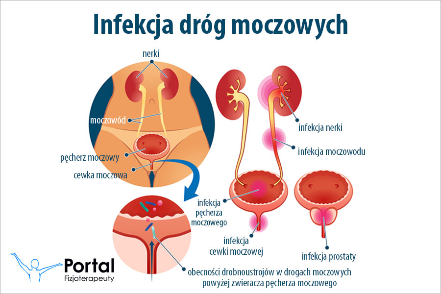 oduczanie pieluchy infekcja układu moczowego