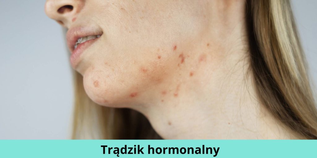 pielęgnacja trądziku hormonalny