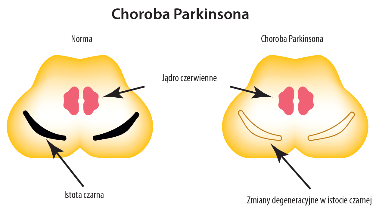 pieluchomajtki w chorobie parkinsona